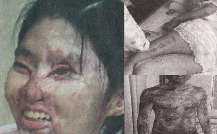 Шалз түлэгдсэн ихэнх хохирогчид эхлэж өөрсдөө өдөж, амнаасаа болж хохирсон баримтууд