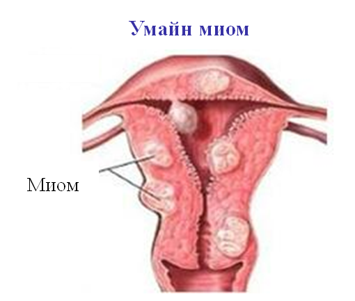 Умайн хоргүй хавдар буюу миом|