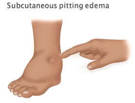 Хаван (Edema) гэж юу вэ?