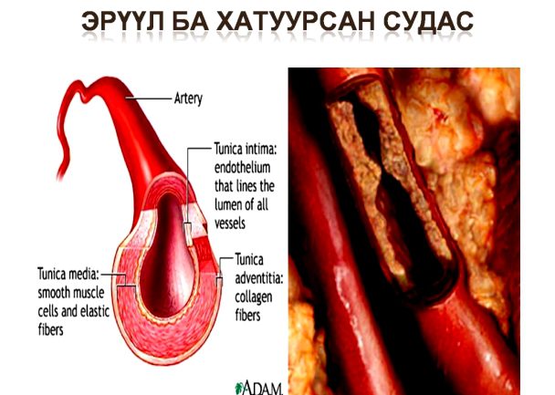 Судас хатуурах өвчин