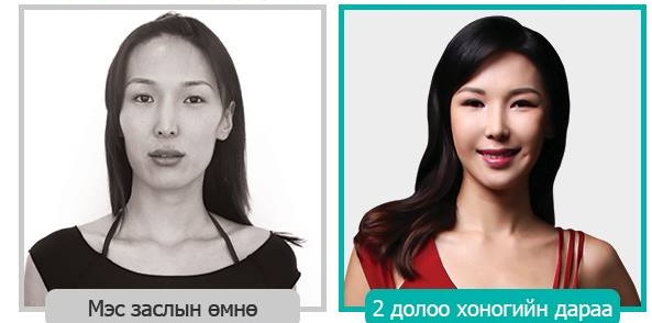 Мисс Э.Сэлэнгэ мэс заслын дараа ингэж өөрчлөгджээ